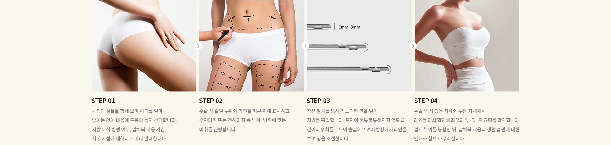 [STEP 01] 사진과 실물을 함께 보며 어디를 얼마나 줄이는 것이 비율에 도움이 될지 상담합니다. 지방 이식 병행 여부, 압박복 착용 기간, 회복 시점에 대해서도 미리 안내합니다. [STEP 02] 수술 시 줄일 부위와 라인을 피부 위에 표시하고 수면마취 또는 전신마취 등 부위·범위에 맞는 마취를 진행합니다. [STEP 03] 작은 절개를 통해 가느다란 관을 넣어 지방을 흡입합니다. 표면이 울퉁불퉁해지지 않도록 깊이와 위치를 나누어 흡입하고 여러 방향에서 라인을 보며 양을 조절합니다. [STEP 04] 수술 후 서 있는 자세와 누운 자세에서 라인을 다시 확인해 좌우와 앞·옆·뒤 균형을 확인합니다. 절개 부위를 봉합한 뒤, 압박복 착용과 생활 습관에 대한 안내와 함께 마무리합니다.