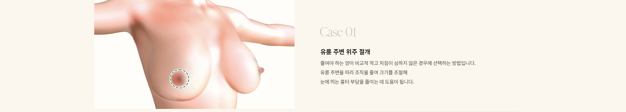 [Case 01] 유륜 주변 위주 절개 : 줄여야 하는 양이 비교적 적고 처짐이 심하지 않은 경우에 선택하는 방법입니다. 유륜 주변을 따라 조직을 줄여 크기를 조절해 눈에 띄는 흉터 부담을 줄이는 데 도움이 됩니다.