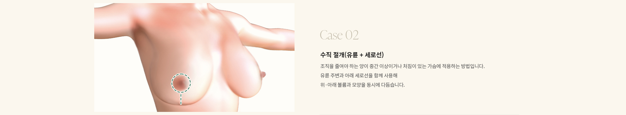 [Case 02] 수직 절개(유륜 + 세로선) : 조직을 줄여야 하는 양이 중간 이상이거나 처짐이 있는 가슴에 적용하는 방법입니다. 유륜 주변과 아래 세로선을 함께 사용해 위·아래 볼륨과 모양을 동시에 다듬습니다.