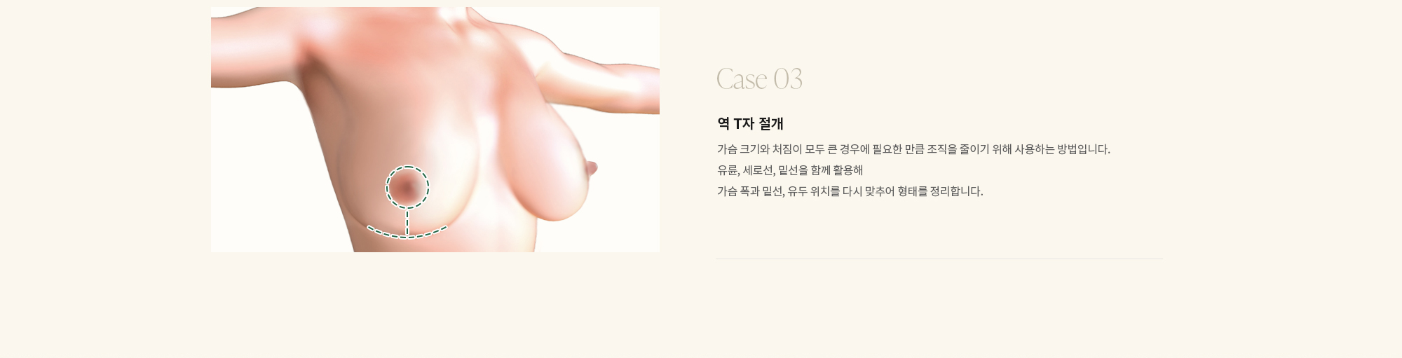 [Case 03] 역 T자 절개 : 가슴 크기와 처짐이 모두 큰 경우에 필요한 만큼 조직을 줄이기 위해 사용하는 방법입니다. 유륜, 세로선, 밑선을 함께 활용해 가슴 폭과 밑선, 유두 위치를 다시 맞추어 형태를 정리합니다.