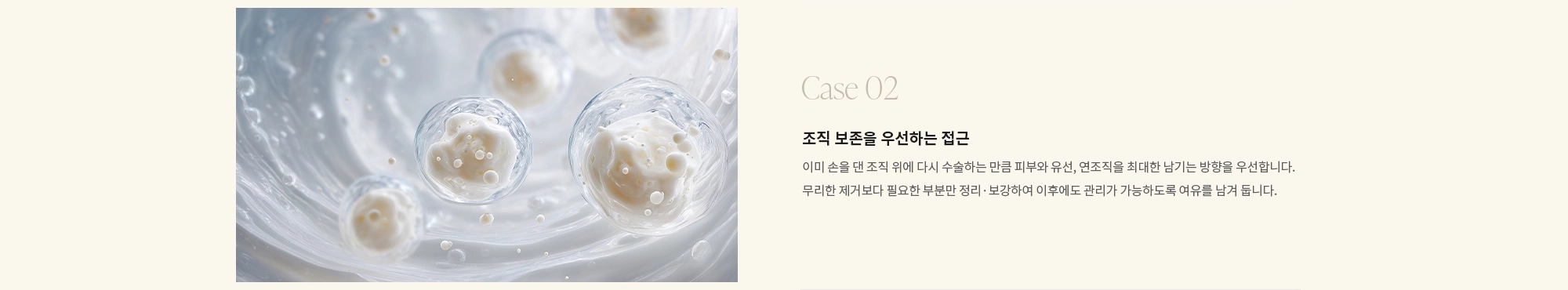 [Case 02] 조직 보존을 우선하는 접근 : 이미 손을 댄 조직 위에 다시 수술하는 만큼 피부와 유선, 연조직을 최대한 남기는 방향을 우선합니다. 무리한 제거보다 필요한 부분만 정리·보강하여 이후에도 관리가 가능하도록 여유를 남겨 둡니다.