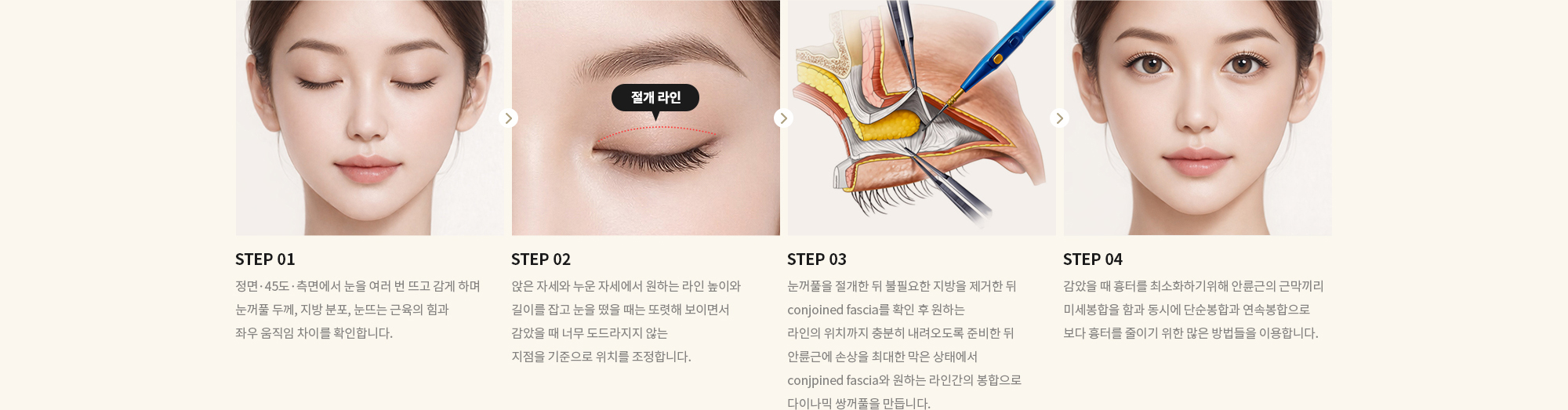 [STEP 01] 정면·45도·측면에서 눈을 여러 번 뜨고 감게 하며 눈꺼풀 두께, 지방 분포, 눈뜨는 근육의 힘과 좌우 움직임 차이를 확인합니다. [STEP 02] 앉은 자세와 누운 자세에서 원하는 라인 높이와 길이를 잡고 눈을 떴을 때는 또렷해 보이면서 감았을 때 너무 도드라지지 않는 지점을 기준으로 위치를 조정합니다. [STEP 03] 눈꺼풀을 절개한 뒤 불필요한 지방과 두꺼운 조직을 조절하고 눈 뜨는 근육과 피부·안륜근 사이 연결 구조를 세밀하게 맞춰 눈을 뜰 때 근육이 자연스럽게 라인을 접히게 합니다. [STEP 04] 눈을 뜨고 감을 때, 웃을 때의 변화를 보며 라인이 접히는 위치와 깊이를 미세 조정하고 이후 붓기·멍·흉터 관리와 회복 케어를 함께 진행합니다.