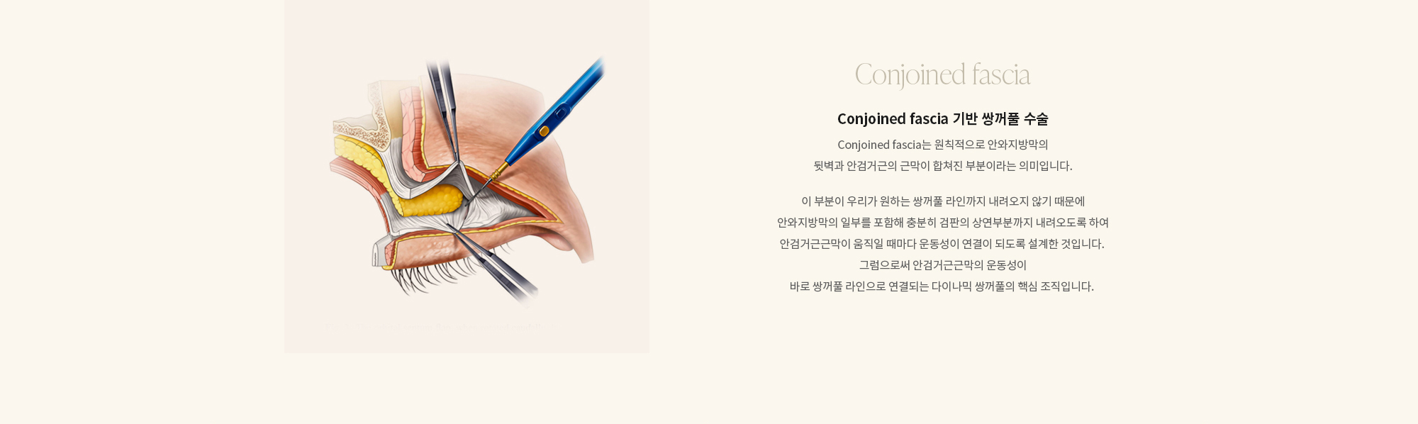 [Conjoint Fascia] Conjoint Fascia 기반 쌍꺼풀 수술 : 리앤웰은 Conjoint Fascia 구조를 정확히 이해한 차별화된 술기를 바탕으로, 눈을 뜰 때의 움직임을 방해하지 않도록 구조적으로 설계해 졸려 보이거나 인위적인 인상을 줄입니다. 겉피부만 고정하는 기존 방식과 달리, 눈을 뜨는 힘이 전달되는 층과 함께 라인을 만들어 풀림이 적고 표정이 부드러운 쌍꺼풀을 구현합니다. 또한 Conjoint Fascia 에 대한 깊은 이해를 바탕으로 눈 구조와 눈뜨는 힘에 따라 다이나믹 술기와 스태틱 술기를 선택적으로 적용해, 자연스러운 움직임은 유지하면서도 필요한 경우에는 라인의 안정성을 높인 균형 잡힌 쌍꺼풀 라인을 완성합니다.
