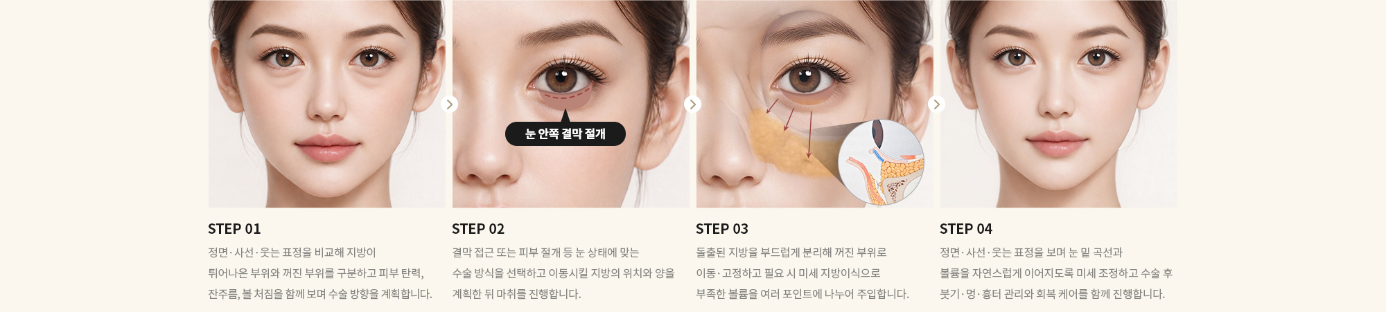 [STEP 01] 정면·사선·웃는 표정을 비교해 지방이 튀어나온 부위와 꺼진 부위를 구분하고 피부 탄력, 잔주름, 볼 처짐을 함께 보며 수술 방향을 계획합니다. [STEP 02] 결막 접근 또는 피부 절개 등 눈 상태에 맞는 수술 방식을 선택하고 이동시킬 지방의 위치와 양을 계획한 뒤 마취를 진행합니다. [STEP 03] 돌출된 지방을 부드럽게 분리해 꺼진 부위로 이동·고정하고 필요 시 미세 지방이식으로 부족한 볼륨을 여러 포인트에 나누어 주입합니다. [STEP 04] 정면·사선·웃는 표정을 보며 눈 밑 곡선과 볼륨을 자연스럽게 이어지도록 미세 조정하고 수술 후 붓기·멍·흉터 관리와 회복 케어를 함께 진행합니다.