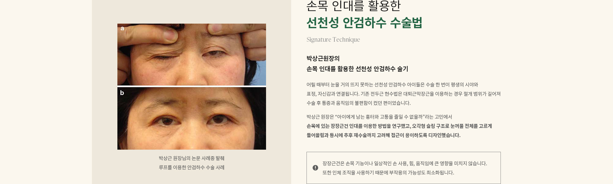 [손목 인대를 활용한 선천성 안검하수 수술법] 박상근원장의 손목 인대를 활용한 선천성 안검하수 술기 : 어릴 때부터 눈을 거의 뜨지 못하는 선천성 안검하수 아이들은 수술 한 번이 평생의 시야와 표정, 자신감과 연결됩니다. 기존 전두근 현수법은 대퇴근막장근을 이용하는 경우 절개 범위가 길어져 수술 후 통증과 움직임의 불편함이 컸던 편이었습니다. 박상근 원장은 “아이에게 남는 흉터와 고통을 줄일 수 없을까”라는 고민에서 손목에 있는 장장근건 인대를 이용한 방법을 연구했고, 오각형 슬링 구조로 눈꺼풀 전체를 고르게 들어올림과 동시에 추후 재수술까지 고려해 접근이 용이하도록 디자인했습니다.장장근건은 손목 기능이나 일상적인 손 사용, 힘, 움직임에 큰 영향을 미치지 않습니다. 또한 인체 조직을 사용하기 때문에 부작용의 가능성도 최소화됩니다.