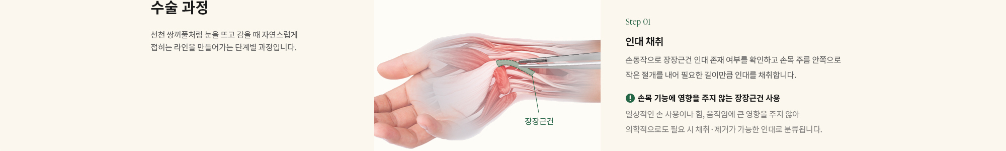 [수술 과정] 선천 쌍꺼풀처럼 눈을 뜨고 감을 때 자연스럽게 접히는 라인을 만들어가는 단계별 과정입니다. Step 01) 인대 채취 : 손동작으로 장장근건 인대 존재 여부를 확인하고 손목 주름 안쪽으로 작은 절개를 내어 필요한 길이만큼 인대를 채취합니다. 손목 기능에 영향을 주지 않는 장장근건 사용일상적인 손 사용이나 힘, 움직임에 큰 영향을 주지 않아 의학적으로도 필요 시 채취·제거가 가능한 인대로 분류됩니다.