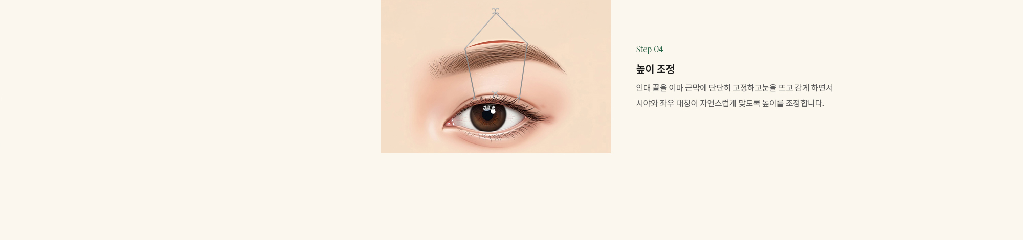 Step 04) 높이 조정 : 인대 끝을 이마 근막에 단단히 고정하고눈을 뜨고 감게 하면서 시야와 좌우 대칭이 자연스럽게 맞도록 높이를 조정합니다.
