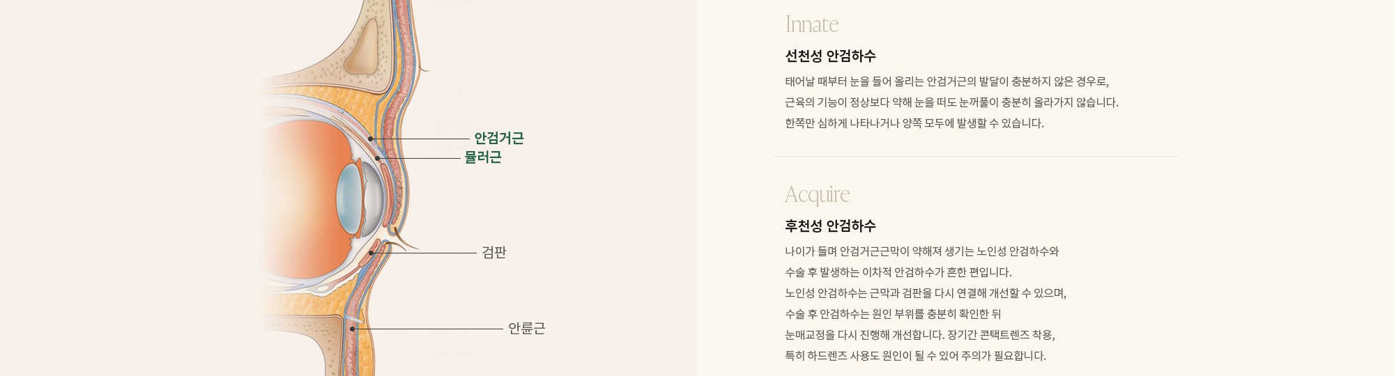 [Innate] 선천성 안검하수 : 태어날 때부터 눈을 들어 올리는 안검거근의 발달이 충분하지 않은 경우로, 근육의 기능이 정상보다 약해 눈을 떠도 눈꺼풀이 충분히 올라가지 않습니다. 한쪽만 심하게 나타나거나 양쪽 모두에 발생할 수 있습니다. 후천성 안검하수 : 나이가 들면서 안검거근의 기능이 약해지거나, 자율신경의 영향을 받는 뮬러근의 기능이 저하되면서 눈을 뜨는 힘이 점차 떨어지는 경우입니다.