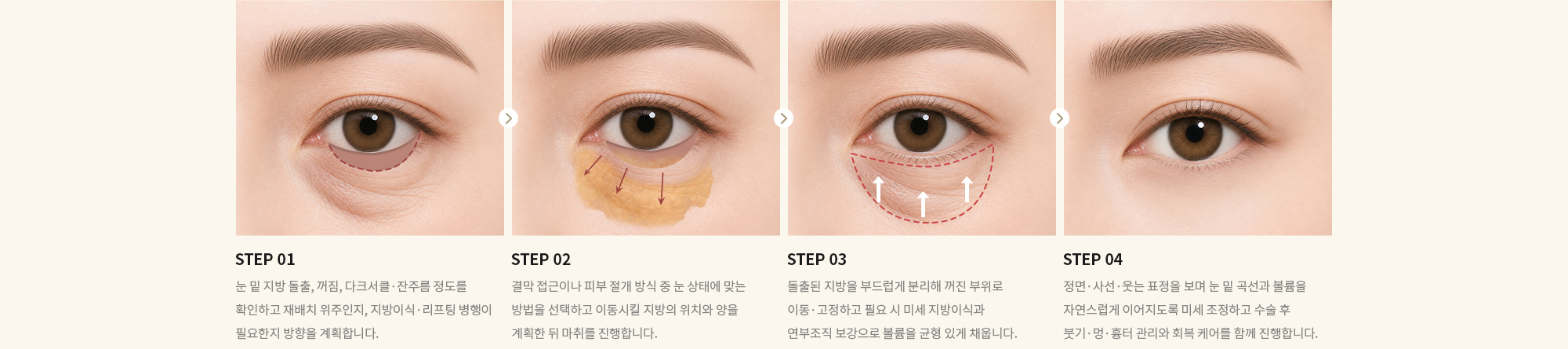 [STEP 01] 눈 밑 지방 돌출, 꺼짐, 다크서클·잔주름 정도를 확인하고 재배치 위주인지, 지방이식·리프팅 병행이 필요한지 방향을 계획합니다. [STEP 02] 결막 접근이나 피부 절개 방식 중 눈 상태에 맞는 방법을 선택하고 이동시킬 지방의 위치와 양을 계획한 뒤 마취를 진행합니다. [STEP 03] 돌출된 지방을 부드럽게 분리해 꺼진 부위로 이동·고정하고 필요 시 미세 지방이식과 연부조직 보강으로 볼륨을 균형 있게 채웁니다. [STEP 04] 정면·사선·웃는 표정을 보며 눈 밑 곡선과 볼륨을 자연스럽게 이어지도록 미세 조정하고 수술 후 붓기·멍·흉터 관리와 회복 케어를 함께 진행합니다.