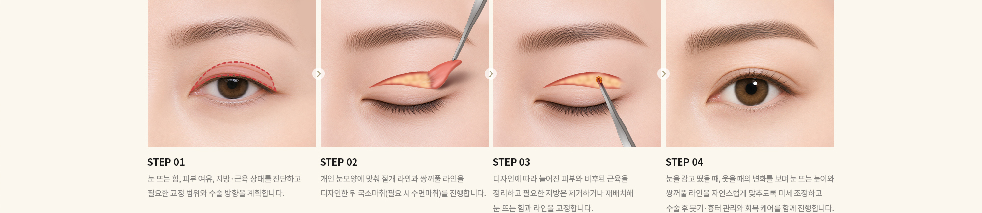 [STEP 01] 눈 뜨는 힘, 피부 여유, 지방·근육 상태를 진단하고 필요한 교정 범위와 수술 방향을 계획합니다. [STEP 02] 개인 눈모양에 맞춰 절개 라인과 쌍꺼풀 라인을 디자인한 뒤 국소마취(필요 시 수면마취)를 진행합니다. [STEP 03] 디자인에 따라 늘어진 피부와 비후된 근육을 정리하고 필요한 지방은 제거하거나 재배치해 눈 뜨는 힘과 라인을 교정합니다. [STEP 04] 눈을 감고 떴을 때, 웃을 때의 변화를 보며 눈 뜨는 높이와 쌍꺼풀 라인을 자연스럽게 맞추도록 미세 조정하고 수술 후 붓기·흉터 관리와 회복 케어를 함께 진행합니다.