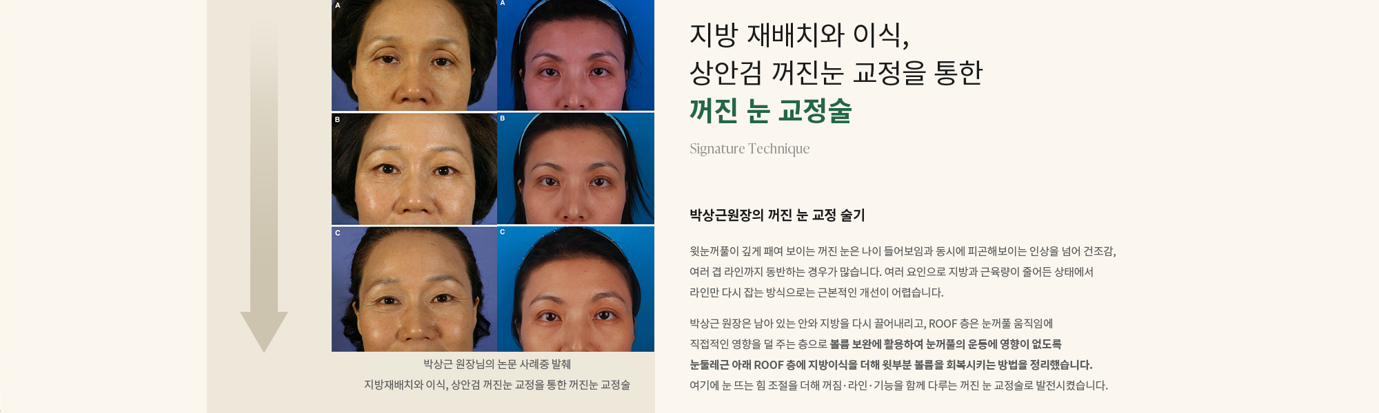 [지방 재배치와 이식, 상안검 꺼진눈 교정을 통한 꺼진 눈 교정술] 박상근원장의 꺼진 눈 교정 술기 : 윗눈꺼풀이 깊게 패여 보이는 꺼진 눈은 나이 들어보임과 동시에 피곤해보이는 인상을 넘어 건조감, 여러 겹 라인까지 동반하는 경우가 많습니다. 여러 요인으로 지방과 근육량이 줄어든 상태에서 라인만 다시 잡는 방식으로는 근본적인 개선이 어렵습니다. 박상근 원장은 남아 있는 안와 지방을 다시 끌어내리고, ROOF 층은 눈꺼풀 움직임에 직접적인 영향을 덜 주는 층으로 볼륨 보완에 활용하여 눈꺼풀의 운동에 영향이 없도록 눈둘레근 아래 ROOF 층에 지방이식을 더해 윗부분 볼륨을 회복시키는 방법을 정리했습니다. 여기에 눈 뜨는 힘 조절을 더해 꺼짐·라인·기능을 함께 다루는 꺼진 눈 교정술로 발전시켰습니다.