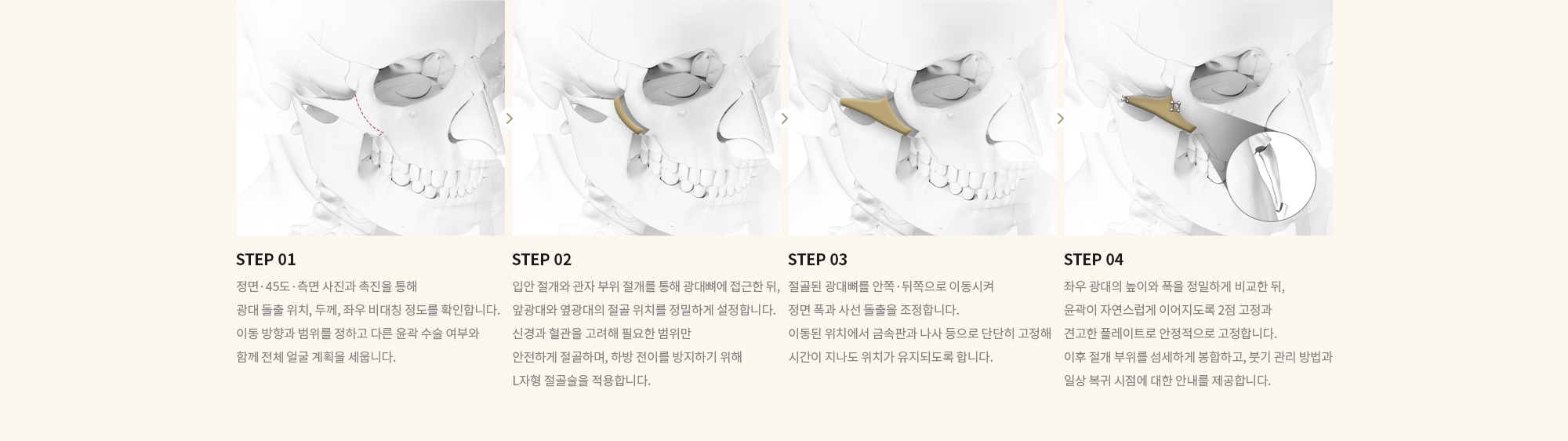 [STEP 01] 정면·45도·측면 사진과 촉진을 통해 광대 돌출 위치, 두께, 좌우 비대칭 정도를 확인합니다. 이동 방향과 범위를 정하고 다른 윤곽 수술 여부와 함께 전체 얼굴 계획을 세웁니다. [STEP 02] 입안 절개와 관자 부위 절개를 통해 광대뼈에 접근한 뒤, 앞광대와 옆광대의 절골 위치를 정밀하게 설정합니다.
신경과 혈관을 고려해 필요한 범위만 안전하게 절골하며, 하방 전이를 방지하기 위해 L자형 절골술을 적용합니다. [STEP 03] 절골된 광대뼈를 안쪽·뒤쪽으로 이동시켜 정면 폭과 사선 돌출을 조정합니다. 이동된 위치에서 금속판과 나사 등으로 단단히 고정해 시간이 지나도 위치가 유지되도록 합니다. [STEP 04] 좌우 광대의 높이와 폭을 정밀하게 비교한 뒤, 윤곽이 자연스럽게 이어지도록 2점 고정과 견고한 플레이트로 안정적으로 고정합니다. 이후 절개 부위를 섬세하게 봉합하고, 붓기 관리 방법과 일상 복귀 시점에 대한 안내를 제공합니다.
