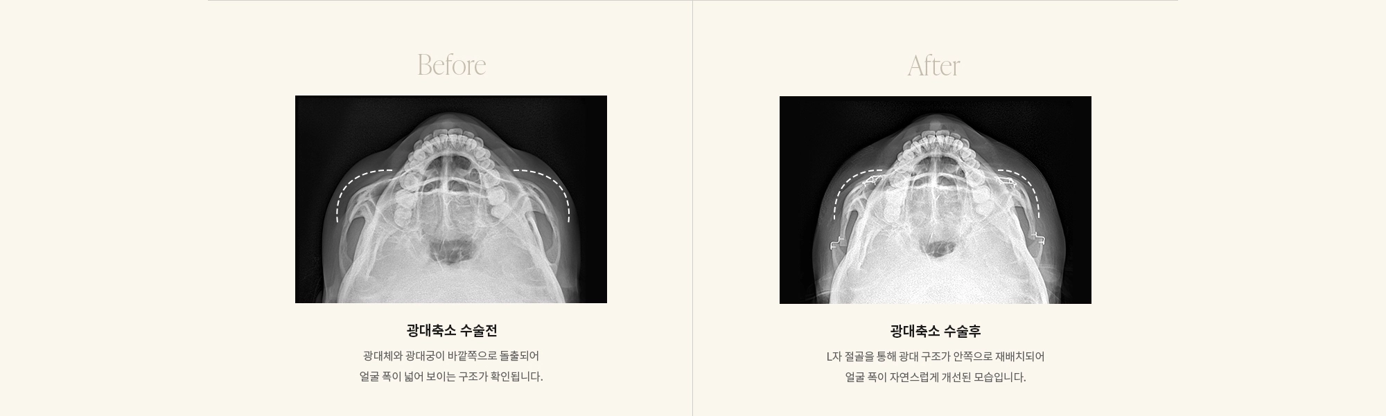 [광대축소 수술전] 광대체와 광대궁이 바깥쪽으로 돌출되어 얼굴 폭이 넓어 보이는 구조가 확인됩니다. / [광대축소 수술후] L자 절골을 통해 광대 구조가 안쪽으로 재배치되어 얼굴 폭이 자연스럽게 개선된 모습입니다.