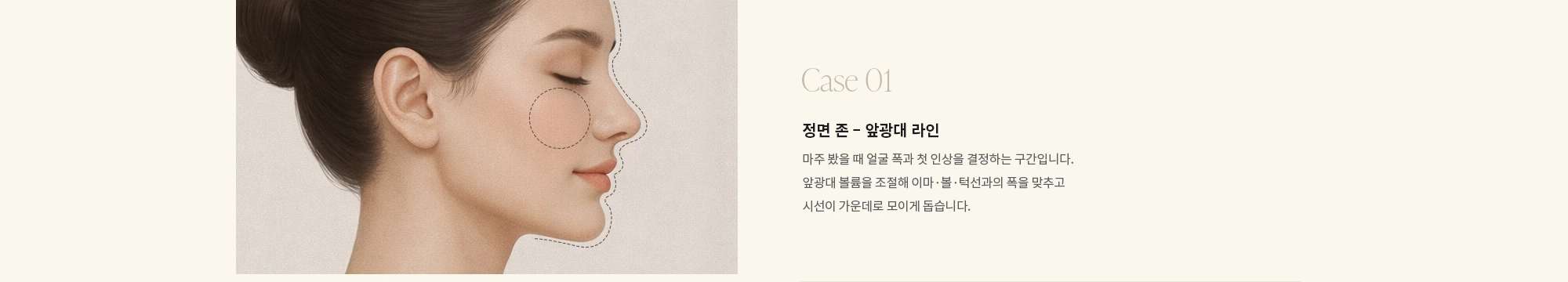 [Case 01] 정면 존 - 앞광대 라인 : 마주 봤을 때 얼굴 폭과 첫 인상을 결정하는 구간입니다. 앞광대 볼륨을 조절해 이마·볼·턱선과의 폭을 맞추고 시선이 가운데로 모이게 돕습니다.