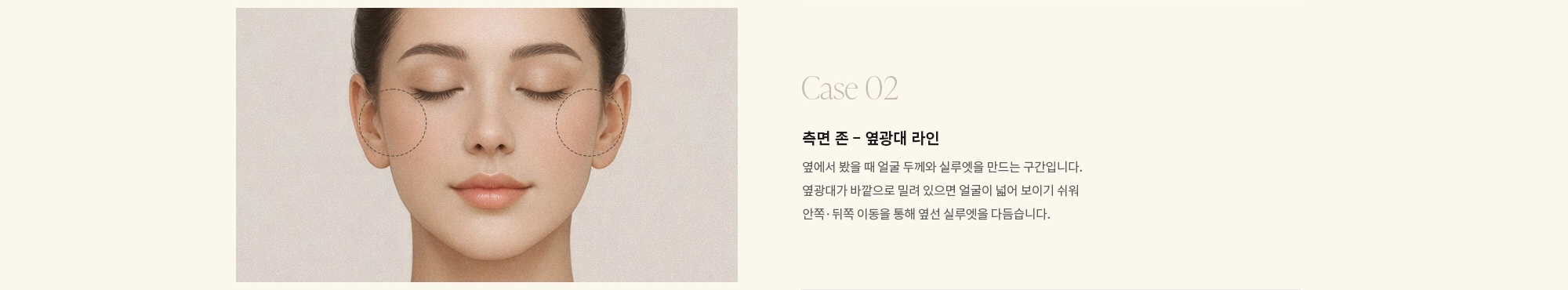 [Case 02] 측면 존 - 옆광대 라인 : 옆에서 봤을 때 얼굴 두께와 실루엣을 만드는 구간입니다. 옆광대가 바깥으로 밀려 있으면 얼굴이 넓어 보이기 쉬워 안쪽·뒤쪽 이동을 통해 옆선 실루엣을 다듬습니다.