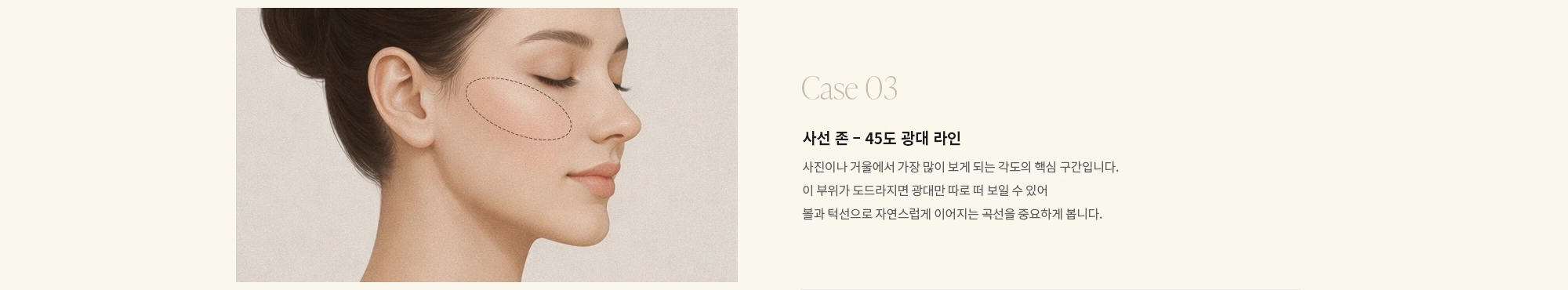 [Case 03] 사선 존 - 45도 광대 라인 : 사진이나 거울에서 가장 많이 보게 되는 각도의 핵심 구간입니다. 이 부위가 도드라지면 광대만 따로 떠 보일 수 있어 볼과 턱선으로 자연스럽게 이어지는 곡선을 중요하게 봅니다.