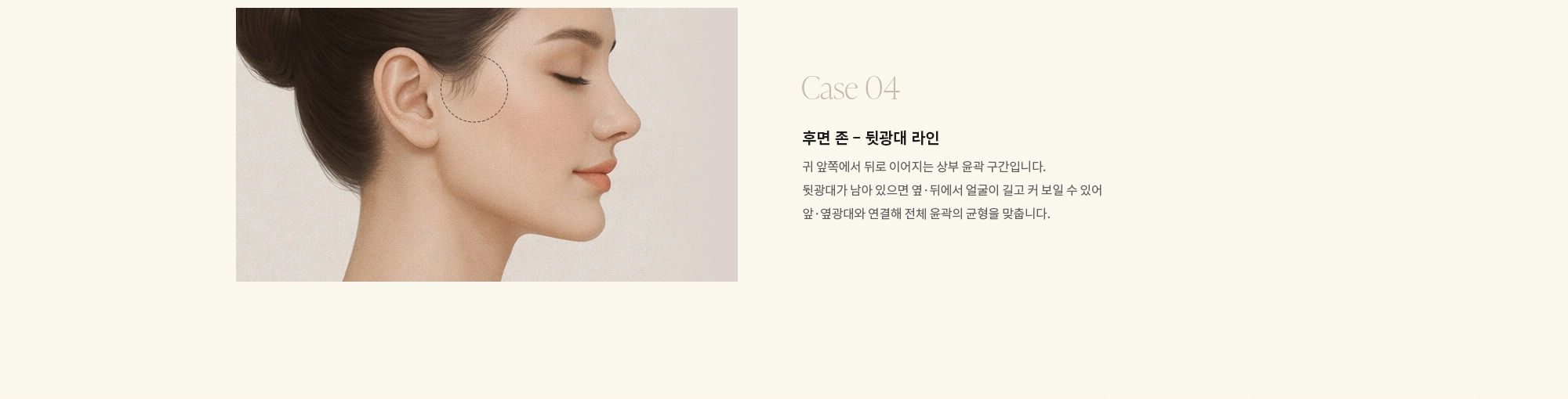 [Case 04] 후면 존 - 뒷광대 라인 : 귀 앞쪽에서 뒤로 이어지는 상부 윤곽 구간입니다. 뒷광대가 남아 있으면 옆·뒤에서 얼굴이 길고 커 보일 수 있어 앞·옆광대와 연결해 전체 윤곽의 균형을 맞춥니다.