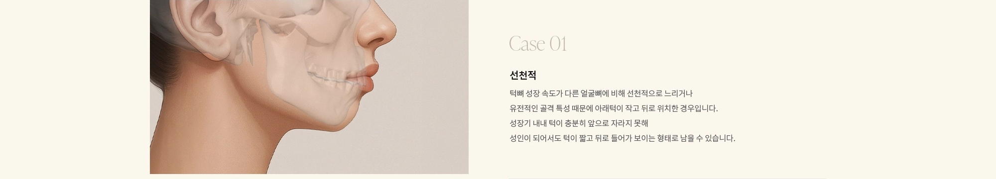 [Case 01] 선천적 : 턱뼈 성장 속도가 다른 얼굴뼈에 비해 선천적으로 느리거나 유전적인 골격 특성 때문에 아래턱이 작고 뒤로 위치한 경우입니다. 성장기 내내 턱이 충분히 앞으로 자라지 못해 성인이 되어서도 턱이 짧고 뒤로 들어가 보이는 형태로 남을 수 있습니다.