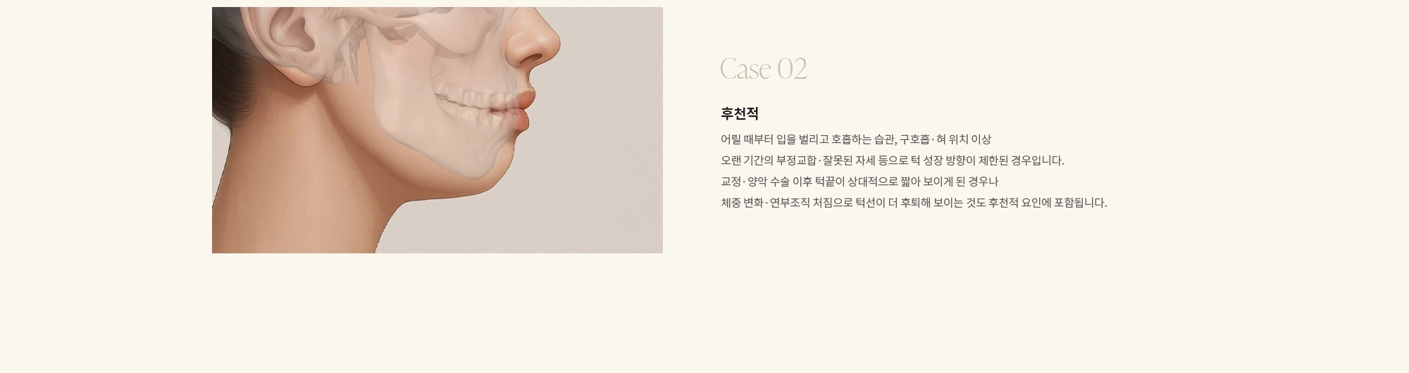 [Case 02] 후천적 : 어릴 때부터 입을 벌리고 호흡하는 습관, 구호흡·혀 위치 이상 오랜 기간의 부정교합·잘못된 자세 등으로 턱 성장 방향이 제한된 경우입니다. 교정·양악 수술 이후 턱끝이 상대적으로 짧아 보이게 된 경우나 체중 변화·연부조직 처짐으로 턱선이 더 후퇴해 보이는 것도 후천적 요인에 포함됩니다.
