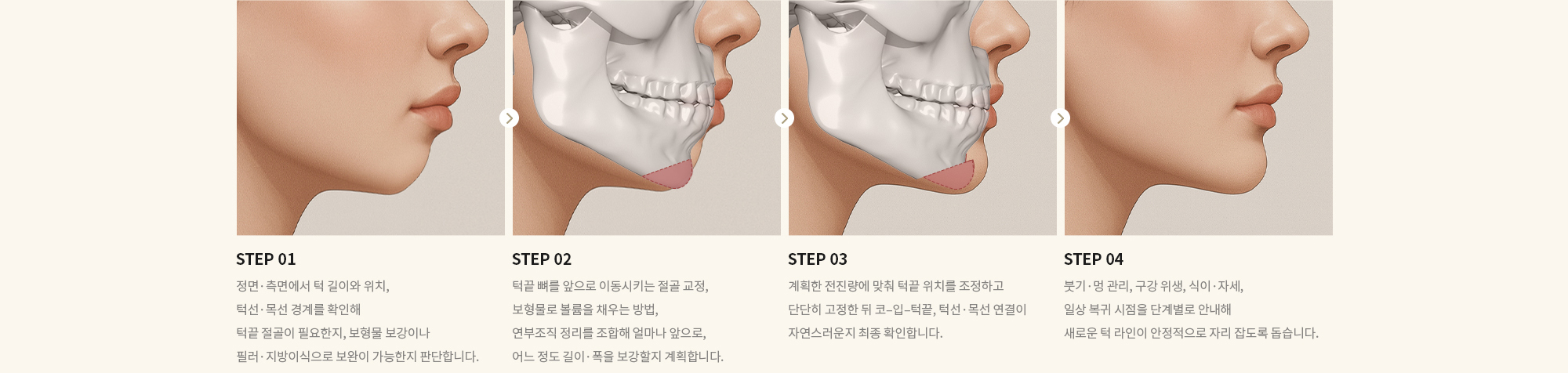 [STEP 01] 정면·측면에서 턱 길이와 위치, 턱선·목선 경계를 확인해 턱끝 절골이 필요한지, 보형물 보강이나 필러·지방이식으로 보완이 가능한지 판단합니다. [STEP 02] 턱끝 뼈를 앞으로 이동시키는 절골 교정, 보형물로 볼륨을 채우는 방법, 연부조직 정리를 조합해 얼마나 앞으로, 어느 정도 길이·폭을 보강할지 계획합니다. [STEP 03] 계획한 전진량에 맞춰 턱끝 위치를 조정하고 단단히 고정한 뒤 코–입–턱끝, 턱선·목선 연결이 자연스러운지 최종 확인합니다. [STEP 04] 붓기·멍 관리, 구강 위생, 식이·자세, 일상 복귀 시점을 단계별로 안내해 새로운 턱 라인이 안정적으로 자리 잡도록 돕습니다.