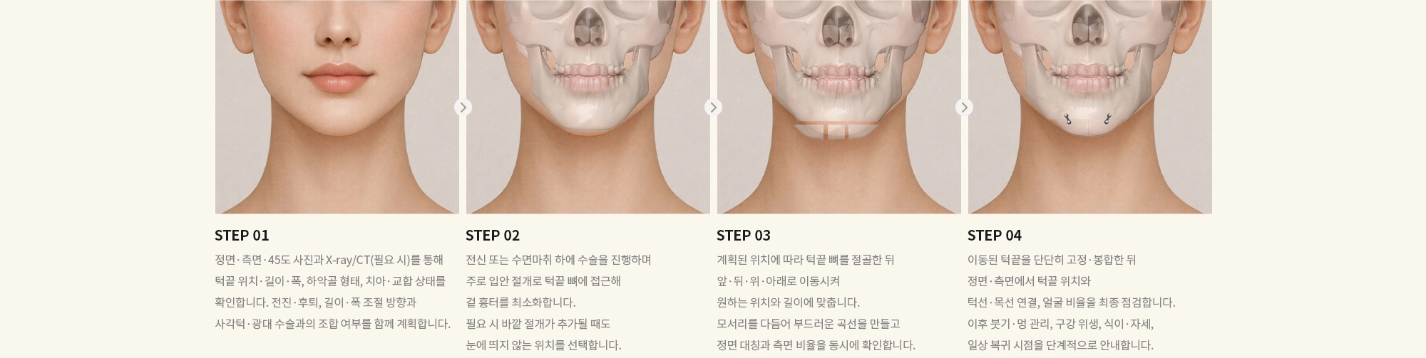 [STEP 01] 정면·측면·45도 사진과 X-ray/CT(필요 시)를 통해 턱끝 위치·길이·폭, 하악골 형태, 치아·교합 상태를 확인합니다. 전진·후퇴, 길이·폭 조절 방향과 사각턱·광대 수술과의 조합 여부를 함께 계획합니다. [STEP 02] 전신 또는 수면마취 하에 수술을 진행하며 주로 입안 절개로 턱끝 뼈에 접근해 겉 흉터를 최소화합니다.  필요 시 바깥 절개가 추가될 때도 눈에 띄지 않는 위치를 선택합니다. [STEP 03] 계획된 위치에 따라 턱끝 뼈를 절골한 뒤 앞·뒤·위·아래로 이동시켜 원하는 위치와 길이에 맞춥니다. 모서리를 다듬어 부드러운 곡선을 만들고 정면 대칭과 측면 비율을 동시에 확인합니다. [STEP 04] 이동된 턱끝을 단단히 고정·봉합한 뒤 정면·측면에서 턱끝 위치와 턱선·목선 연결, 얼굴 비율을 최종 점검합니다. 이후 붓기·멍 관리, 구강 위생, 식이·자세, 일상 복귀 시점을 단계적으로 안내합니다.