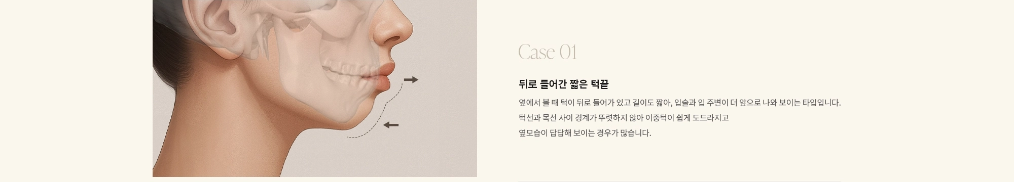 [Case 01] 뒤로 들어간 짧은 턱끝 : 옆에서 볼 때 턱이 뒤로 들어가 있고 길이도 짧아, 입술과 입 주변이 더 앞으로 나와 보이는 타입입니다. 턱선과 목선 사이 경계가 뚜렷하지 않아 이중턱이 쉽게 도드라지고 옆모습이 답답해 보이는 경우가 많습니다.