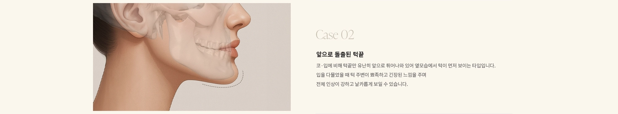 [Case 02] 앞으로 돌출된 턱끝 : 코·입에 비해 턱끝만 유난히 앞으로 튀어나와 있어 옆모습에서 턱이 먼저 보이는 타입입니다. 입을 다물었을 때 턱 주변이 뾰족하고 긴장된 느낌을 주며 전체 인상이 강하고 날카롭게 보일 수 있습니다.