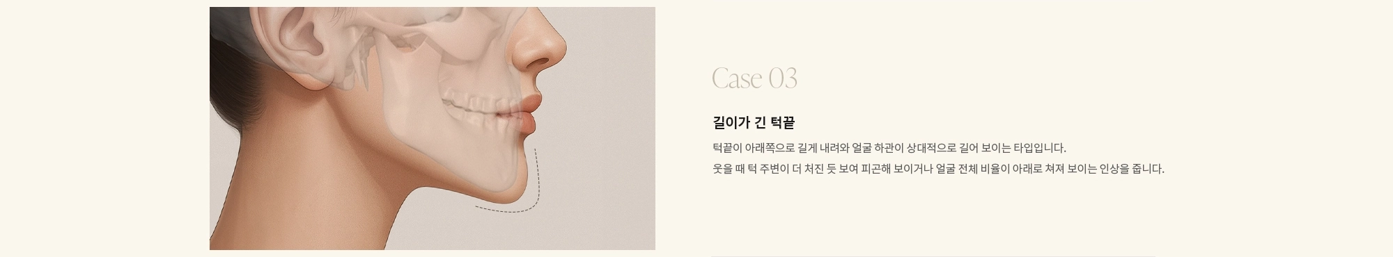 [Case 03] 길이가 긴 턱끝 : 턱끝이 아래쪽으로 길게 내려와 얼굴 하관이 상대적으로 길어 보이는 타입입니다. 웃을 때 턱 주변이 더 처진 듯 보여 피곤해 보이거나 얼굴 전체 비율이 아래로 쳐져 보이는 인상을 줍니다.