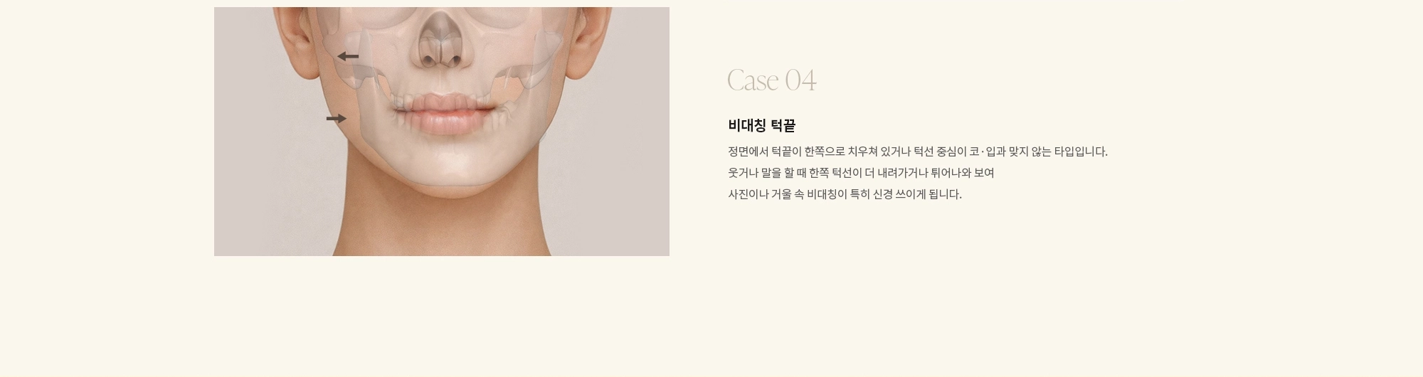 [Case 04] 비대칭 턱끝 : 정면에서 턱끝이 한쪽으로 치우쳐 있거나 턱선 중심이 코·입과 맞지 않는 타입입니다. 웃거나 말을 할 때 한쪽 턱선이 더 내려가거나 튀어나와 보여 사진이나 거울 속 비대칭이 특히 신경 쓰이게 됩니다.