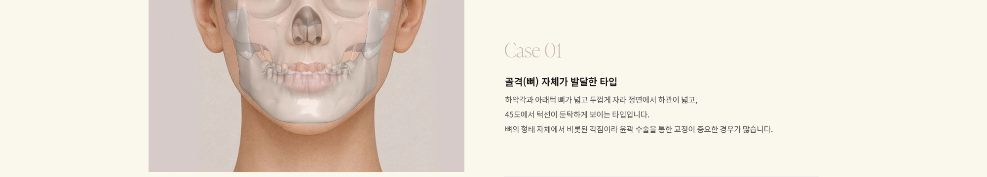 [Case 01] 골격(뼈) 자체가 발달한 타입 : 하악각과 아래턱 뼈가 넓고 두껍게 자라 정면에서 하관이 넓고, 45도에서 턱선이 둔탁하게 보이는 타입입니다. 뼈의 형태 자체에서 비롯된 각짐이라 윤곽 수술을 통한 교정이 중요한 경우가 많습니다.