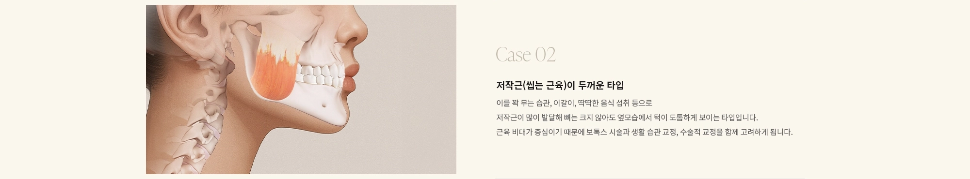 [Case 02] 저작근(씹는 근육)이 두꺼운 타입 : 이를 꽉 무는 습관, 이갈이, 딱딱한 음식 섭취 등으로 저작근이 많이 발달해 뼈는 크지 않아도 옆모습에서 턱이 도톰하게 보이는 타입입니다. 근육 비대가 중심이기 때문에 보톡스 시술과 생활 습관 교정, 수술적 교정을 함께 고려하게 됩니다.