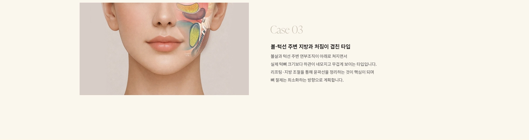 [Case 03] 볼·턱선 주변 지방과 처짐이 겹친 타입 : 볼살과 턱선 주변 연부조직이 아래로 쳐지면서 실제 턱뼈 크기보다 하관이 네모지고 무겁게 보이는 타입입니다. 리프팅·지방 조절을 통해 윤곽선을 정리하는 것이 핵심이 되며 뼈 절제는 최소화하는 방향으로 계획합니다.