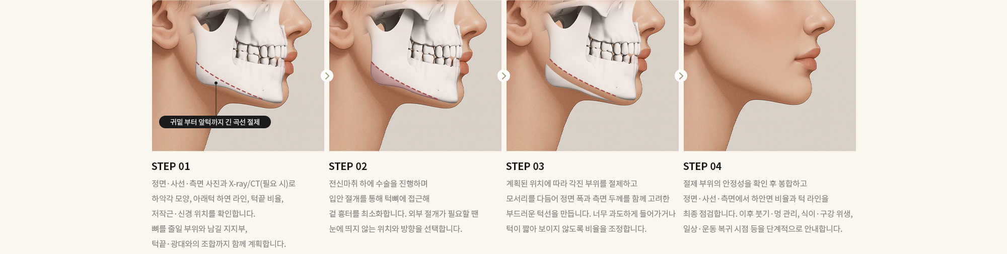 [STEP 01] 정면·사선·측면 사진과 X-ray/CT(필요 시)로 하악각 모양, 아래턱 하연 라인, 턱끝 비율, 저작근·신경 위치를 확인합니다. 뼈를 줄일 부위와 남길 지지부, 턱끝·광대와의 조합까지 함께 계획합니다. [STEP 02] 전신마취 하에 수술을 진행하며 입안 절개를 통해 턱뼈에 접근해 겉 흉터를 최소화합니다. 외부 절개가 필요할 땐 눈에 띄지 않는 위치와 방향을 선택합니다. [STEP 03] 계획된 위치에 따라 각진 부위를 절제하고 모서리를 다듬어 정면 폭과 측면 두께를 함께 고려한 부드러운 턱선을 만듭니다. 너무 과도하게 들어가거나 턱이 짧아 보이지 않도록 비율을 조정합니다. [STEP 04] 절제 부위의 안정성을 확인 후 봉합하고 정면·사선·측면에서 하안면 비율과 턱 라인을 최종 점검합니다. 이후 붓기·멍 관리, 식이·구강 위생, 일상·운동 복귀 시점 등을 단계적으로 안내합니다.