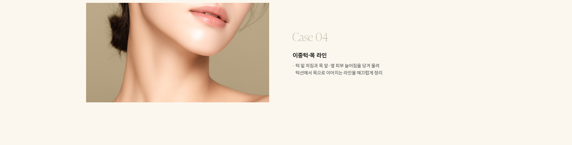 [Case 04] 이중턱·목 라인 : 턱 밑 처짐과 목 앞·옆 피부 늘어짐을 당겨 올려 턱선에서 목으로 이어지는 라인을 매끄럽게 정리