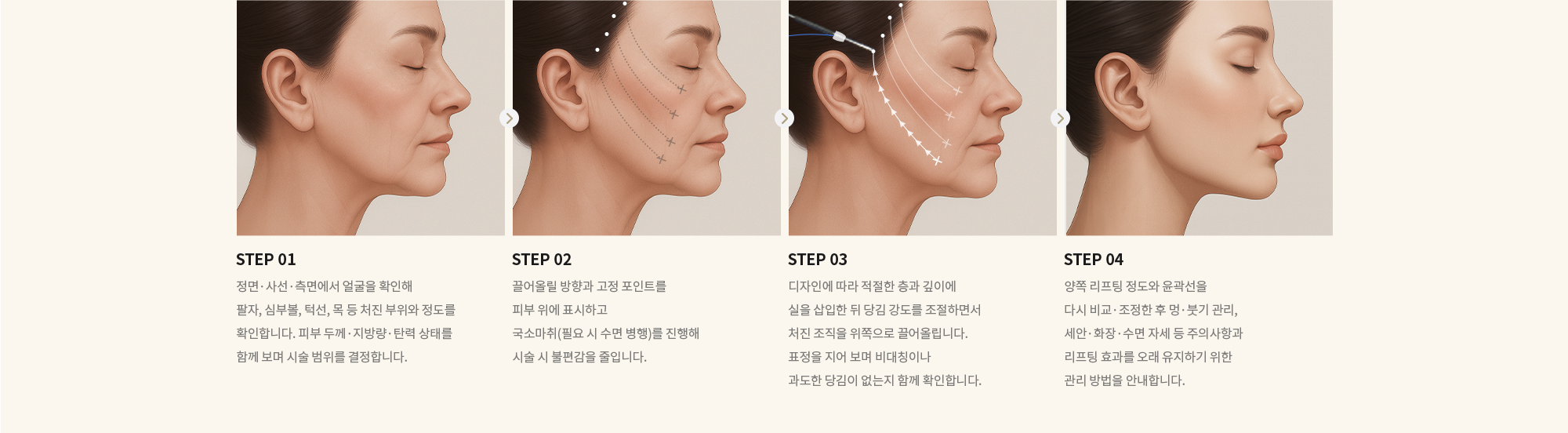 [STEP 01] 정면·사선·측면에서 얼굴을 확인해 팔자, 심부볼, 턱선, 목 등 처진 부위와 정도를 확인합니다. 피부 두께·지방량·탄력 상태를 함께 보며 시술 범위를 결정합니다. [STEP 02] 끌어올릴 방향과 고정 포인트를 피부 위에 표시하고 국소마취(필요 시 수면 병행)를 진행해 시술 시 불편감을 줄입니다. [STEP 03] 디자인에 따라 적절한 층과 깊이에 실을 삽입한 뒤 당김 강도를 조절하면서 처진 조직을 위쪽으로 끌어올립니다. 표정을 지어 보며 비대칭이나 과도한 당김이 없는지 함께 확인합니다. [STEP 04] 양쪽 리프팅 정도와 윤곽선을 다시 비교·조정한 후 멍·붓기 관리, 세안·화장·수면 자세 등 주의사항과 리프팅 효과를 오래 유지하기 위한 관리 방법을 안내합니다.