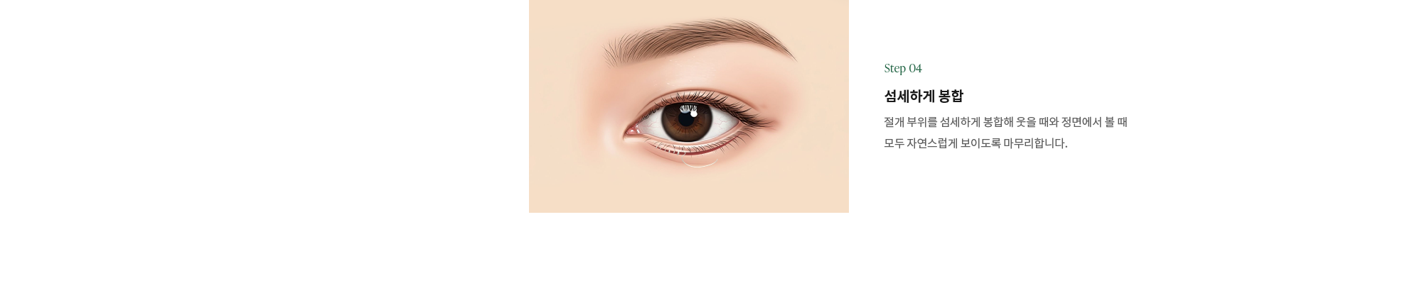 (Point 04) 섬세하게 봉합 : 절개 부위를 섬세하게 봉합해 웃을 때와 정면에서 볼 때 모두 자연스럽게 보이도록 마무리합니다.