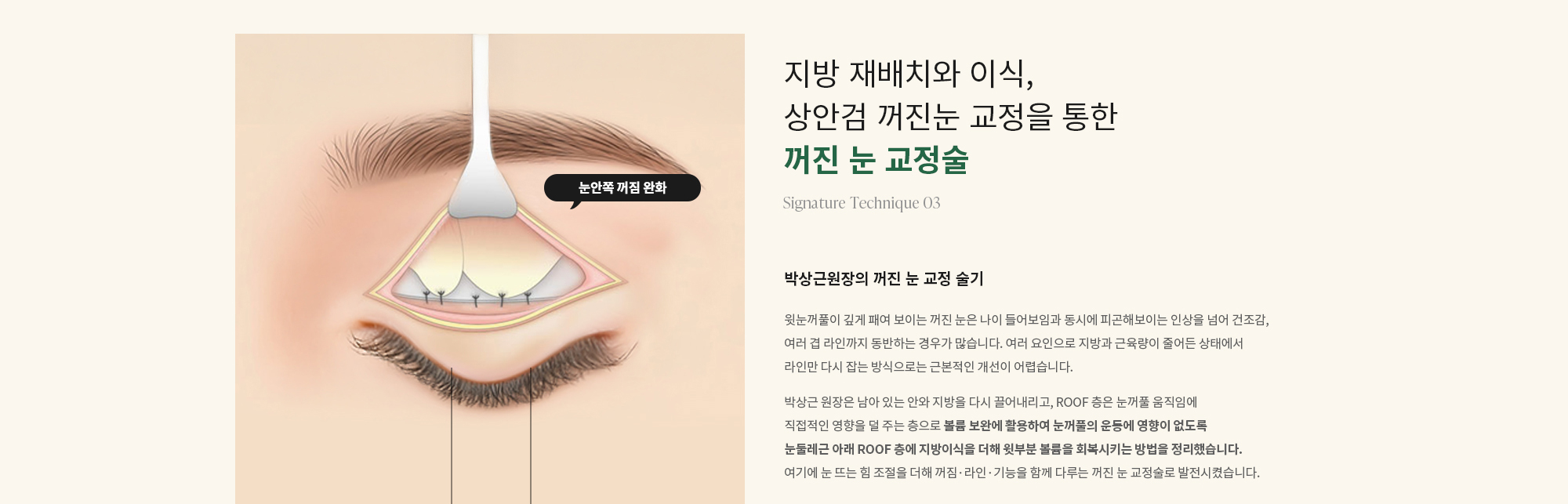 [지방 재배치와 이식, 상안검 꺼진눈 교정을 통한 꺼진 눈 교정술] 박상근원장의 꺼진 눈 교정 술기 : 윗눈꺼풀이 깊게 패여 보이는 꺼진 눈은 나이 들어보임과 동시에 피곤해보이는 인상을 넘어 건조감, 여러 겹 라인까지 동반하는 경우가 많습니다. 여러 요인으로 지방과 근육량이 줄어든 상태에서 라인만 다시 잡는 방식으로는 근본적인 개선이 어렵습니다. 박상근 원장은 남아 있는 안와 지방을 다시 끌어내리고, ROOF 층은 눈꺼풀 움직임에 직접적인 영향을 덜 주는 층으로 볼륨 보완에 활용하여 눈꺼풀의 운동에 영향이 없도록 눈둘레근 아래 ROOF 층에 지방이식을 더해 윗부분 볼륨을 회복시키는 방법을 정리했습니다. 여기에 눈 뜨는 힘 조절을 더해 꺼짐·라인·기능을 함께 다루는 꺼진 눈 교정술로 발전시켰습니다.