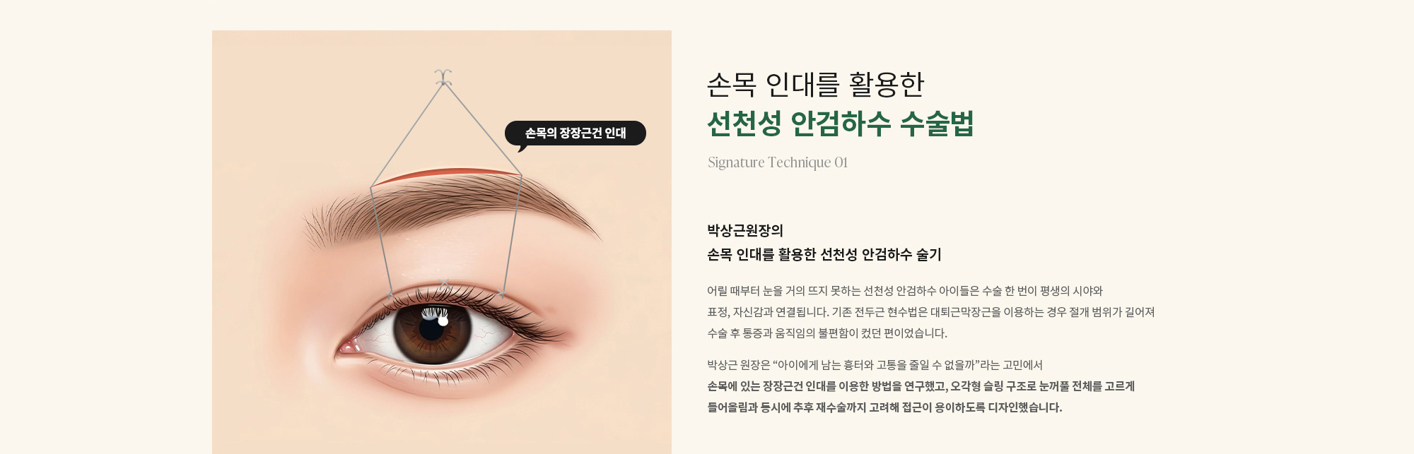 [손목 인대를 활용한 선천성 안검하수 수술법] 박상근원장의 손목 인대를 활용한 선천성 안검하수 술기 : 어릴 때부터 눈을 거의 뜨지 못하는 선천성 안검하수 아이들은 수술 한 번이 평생의 시야와 표정, 자신감과 연결됩니다. 기존 전두근 현수법은 대퇴근막장근을 이용하는 경우 절개 범위가 길어져 수술 후 통증과 움직임의 불편함이 컸던 편이었습니다. 박상근 원장은 “아이에게 남는 흉터와 고통을 줄일 수 없을까”라는 고민에서 손목에 있는 장장근건 인대를 이용한 방법을 연구했고, 오각형 슬링 구조로 눈꺼풀 전체를 고르게 들어올림과 동시에 추후 재수술까지 고려해 접근이 용이하도록 디자인했습니다.