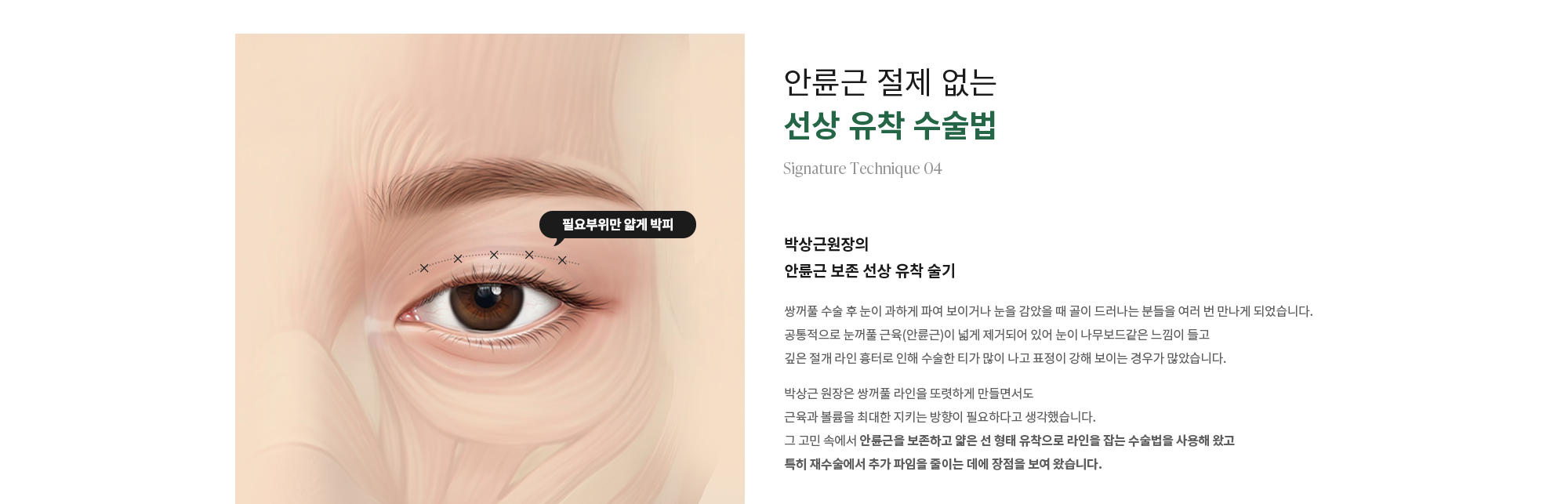 [안륜근 절제 없는 선상 유착 수술법] 박상근원장의 안륜근 보존 선상 유착 술기 : 쌍꺼풀 수술 후 눈이 과하게 파여 보이거나 눈을 감았을 때 골이 드러나는 분들을 여러 번 만나게 되었습니다. 공통적으로 눈꺼풀 근육(안륜근)이 넓게 제거되어 있어 눈이 나무보드같은 느낌이 들고 깊은 절개 라인 흉터로 인해 수술한 티가 많이 나고 표정이 강해 보이는 경우가 많았습니다. 박상근 원장은 쌍꺼풀 라인을 또렷하게 만들면서도 근육과 볼륨을 최대한 지키는 방향이 필요하다고 생각했습니다. 그 고민 속에서 안륜근을 보존하고 얇은 선 형태 유착으로 라인을 잡는 수술법을 사용해 왔고 특히 재수술에서 추가 파임을 줄이는 데에 장점을 보여 왔습니다.