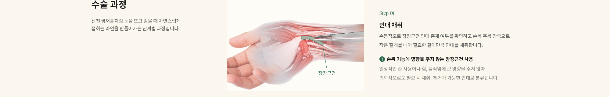 [수술 과정] 선천 쌍꺼풀처럼 눈을 뜨고 감을 때 자연스럽게 접히는 라인을 만들어가는 단계별 과정입니다. (Point 01) 인대 채취 : 손동작으로 장장근건 인대 존재 여부를 확인하고 손목 주름 안쪽으로 작은 절개를 내어 필요한 길이만큼 인대를 채취합니다.