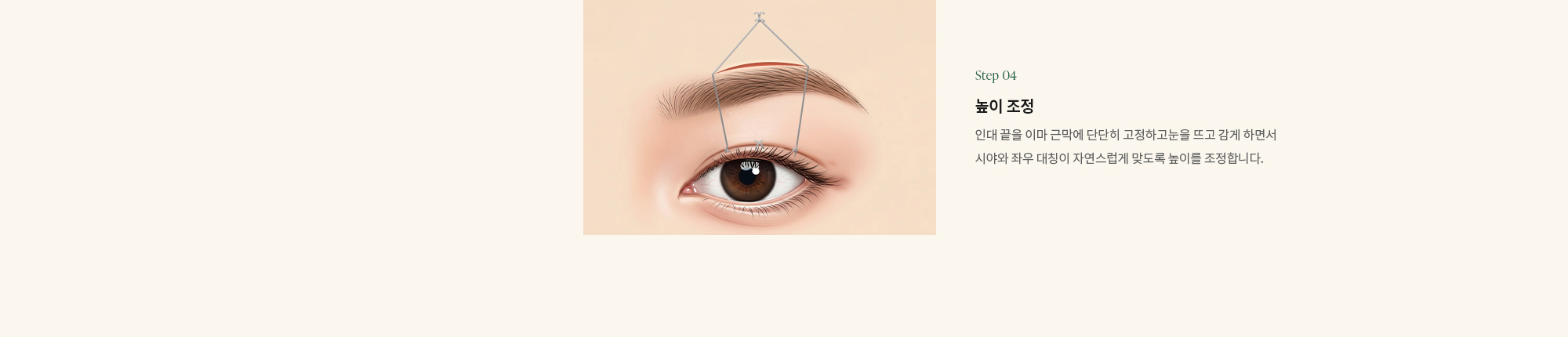 (Point 04) 높이 조정 : 인대 끝을 이마 근막에 단단히 고정하고눈을 뜨고 감게 하면서 시야와 좌우 대칭이 자연스럽게 맞도록 높이를 조정합니다.