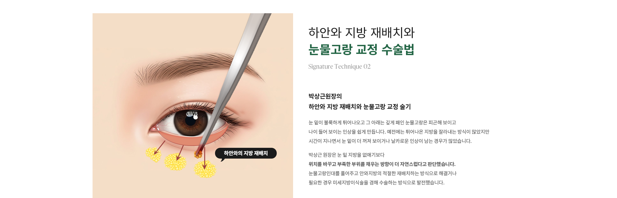 [하안와 지방 재배치와 눈물고랑 교정 수술법] 박상근원장의 하안와 지방 재배치와 눈물고랑 교정 술기 : 눈 밑이 불룩하게 튀어나오고 그 아래는 깊게 패인 눈물고랑은 피곤해 보이고 나이 들어 보이는 인상을 쉽게 만듭니다. 예전에는 튀어나온 지방을 잘라내는 방식이 많았지만 시간이 지나면서 눈 밑이 더 꺼져 보이거나 날카로운 인상이 남는 경우가 많았습니다. 박상근 원장은 눈 밑 지방을 없애기보다 위치를 바꾸고 부족한 부위를 채우는 방향이 더 자연스럽다고 판단했습니다. 눈물고랑인대를 풀어주고 안와지방의 적절한 재배치하는 방식으로 해결거나 필요한 경우 미세지방이식술을 겸해 수술하는 방식으로 발전했습니다.
