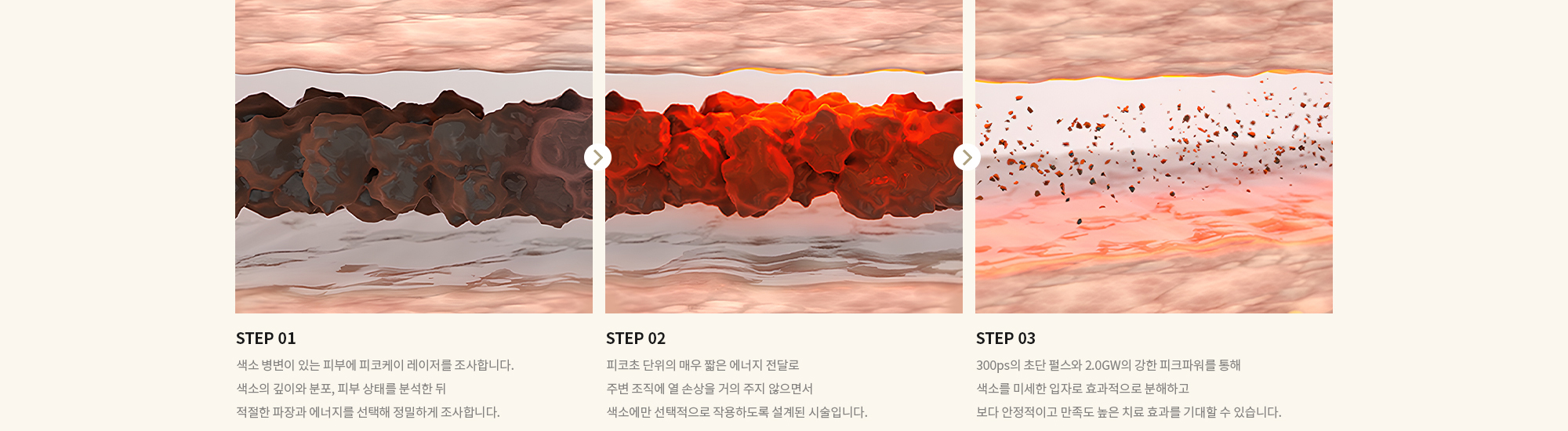 [STEP 01] 색소 병변이 있는 피부에 피코케이 레이저를 조사합니다. 색소의 깊이와 분포, 피부 상태를 분석한 뒤 적절한 파장과 에너지를 선택해 정밀하게 조사합니다. [STEP 02] 피코초 단위의 매우 짧은 에너지 전달로 주변 조직에 열 손상을 거의 주지 않으면서 색소에만 선택적으로 작용하도록 설계된 시술입니다. [STEP 03] 300ps의 초단 펄스와 2.0GW의 강한 피크파워를 통해 색소를 미세한 입자로 효과적으로 분해하고 보다 안정적이고 만족도 높은 치료 효과를 기대할 수 있습니다.
