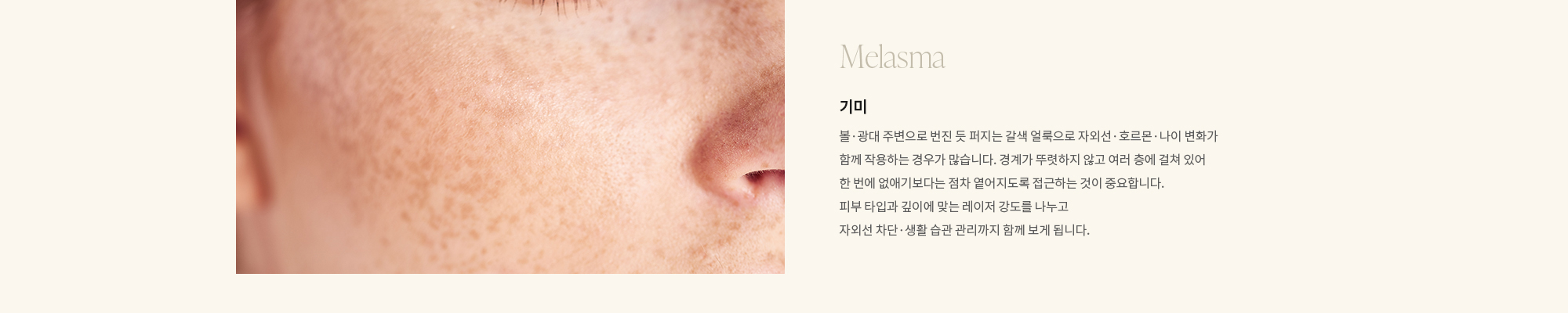 [Melasma] 기미 : 볼·광대 주변으로 번진 듯 퍼지는 갈색 얼룩으로 자외선·호르몬·나이 변화가 함께 작용하는 경우가 많습니다. 경계가 뚜렷하지 않고 여러 층에 걸쳐 있어 한 번에 없애기보다는 점차 옅어지도록 접근하는 것이 중요합니다. 피부 타입과 깊이에 맞는 레이저 강도를 나누고 자외선 차단·생활 습관 관리까지 함께 보게 됩니다.