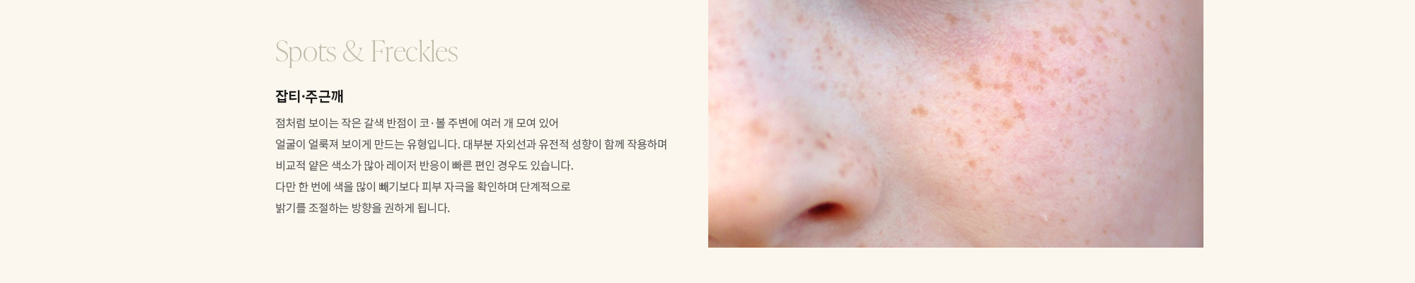 [Spots & Freckles] 잡티·주근깨 : 점처럼 보이는 작은 갈색 반점이 코·볼 주변에 여러 개 모여 있어 얼굴이 얼룩져 보이게 만드는 유형입니다. 대부분 자외선과 유전적 성향이 함께 작용하며 비교적 얕은 색소가 많아 레이저 반응이 빠른 편인 경우도 있습니다. 다만 한 번에 색을 많이 빼기보다 피부 자극을 확인하며 단계적으로 밝기를 조절하는 방향을 권하게 됩니다.