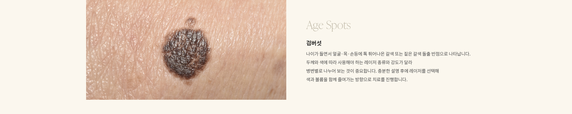 [Age Spots] 검버섯 : 나이가 들면서 얼굴·목·손등에 톡 튀어나온 갈색 또는 짙은 갈색 돌출 반점으로 나타납니다. 두께와 색에 따라 사용해야 하는 레이저 종류와 강도가 달라 병변별로 나누어 보는 것이 중요합니다. 충분한 설명 후에 레이저를 선택해 색과 볼륨을 함께 줄여가는 방향으로 치료를 진행합니다.