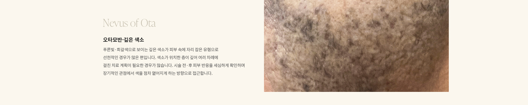 [Nevus of Ota] 오타모반·깊은 색소 : 푸른빛·회갈색으로 보이는 깊은 색소가 피부 속에 자리 잡은 유형으로 선천적인 경우가 많은 편입니다. 색소가 위치한 층이 깊어 여러 차례에 걸친 치료 계획이 필요한 경우가 많습니다. 시술 전·후 피부 반응을 세심하게 확인하며 장기적인 관점에서 색을 점차 옅어지게 하는 방향으로 접근합니다.