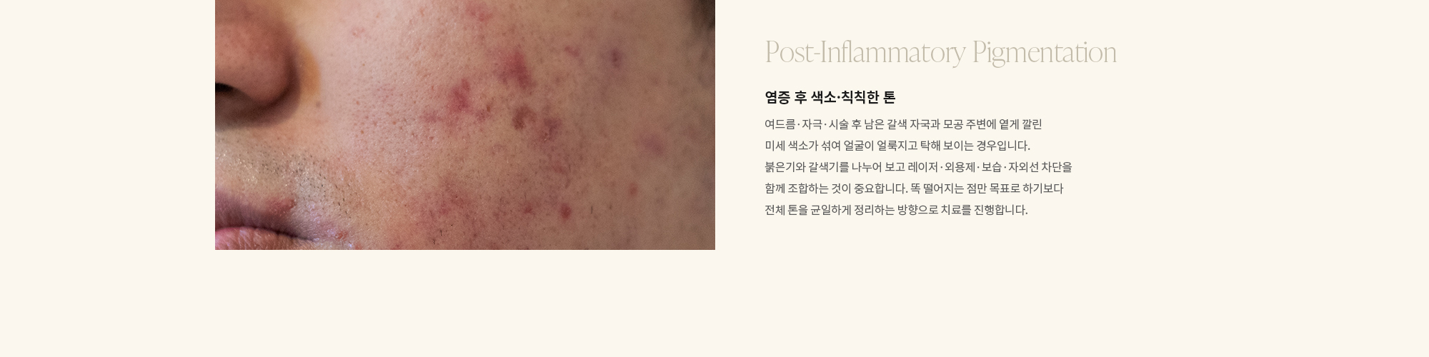 [Post-Inflammatory Pigmentation] 염증 후 색소·칙칙한 톤 : 여드름·자극·시술 후 남은 갈색 자국과 모공 주변에 옅게 깔린 미세 색소가 섞여 얼굴이 얼룩지고 탁해 보이는 경우입니다. 붉은기와 갈색기를 나누어 보고 레이저·외용제·보습·자외선 차단을 함께 조합하는 것이 중요합니다. 똑 떨어지는 점만 목표로 하기보다 전체 톤을 균일하게 정리하는 방향으로 치료를 진행합니다.