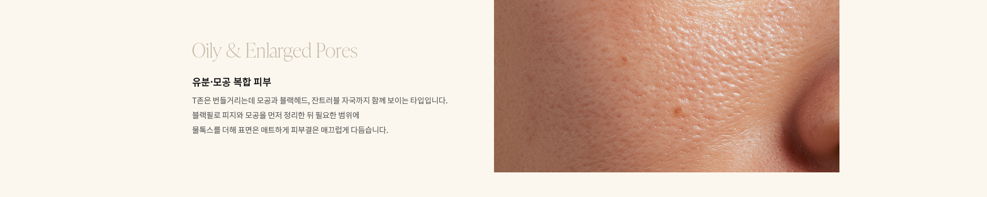 [Oily & Enlarged Pores] 유분·모공 복합 피부 : T존은 번들거리는데 모공과 블랙헤드, 잔트러블 자국까지 함께 보이는 타입입니다. 블랙필로 피지와 모공을 먼저 정리한 뒤 필요한 범위에 물톡스를 더해 표면은 매트하게 피부결은 매끄럽게 다듬습니다.