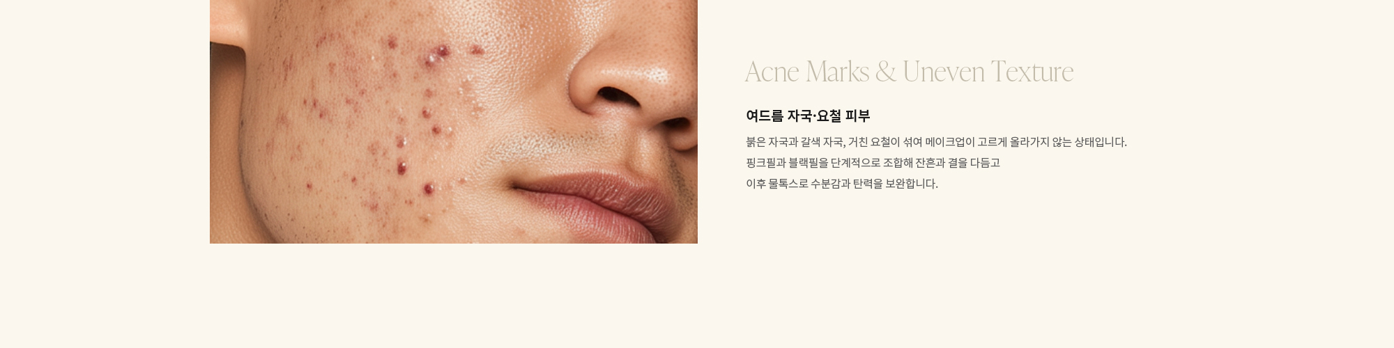 [Acne Marks & Uneven Texture] 여드름 자국·요철 피부 : 붉은 자국과 갈색 자국, 거친 요철이 섞여 메이크업이 고르게 올라가지 않는 상태입니다. 핑크필과 블랙필을 단계적으로 조합해 잔흔과 결을 다듬고 이후 물톡스로 수분감과 탄력을 보완합니다.